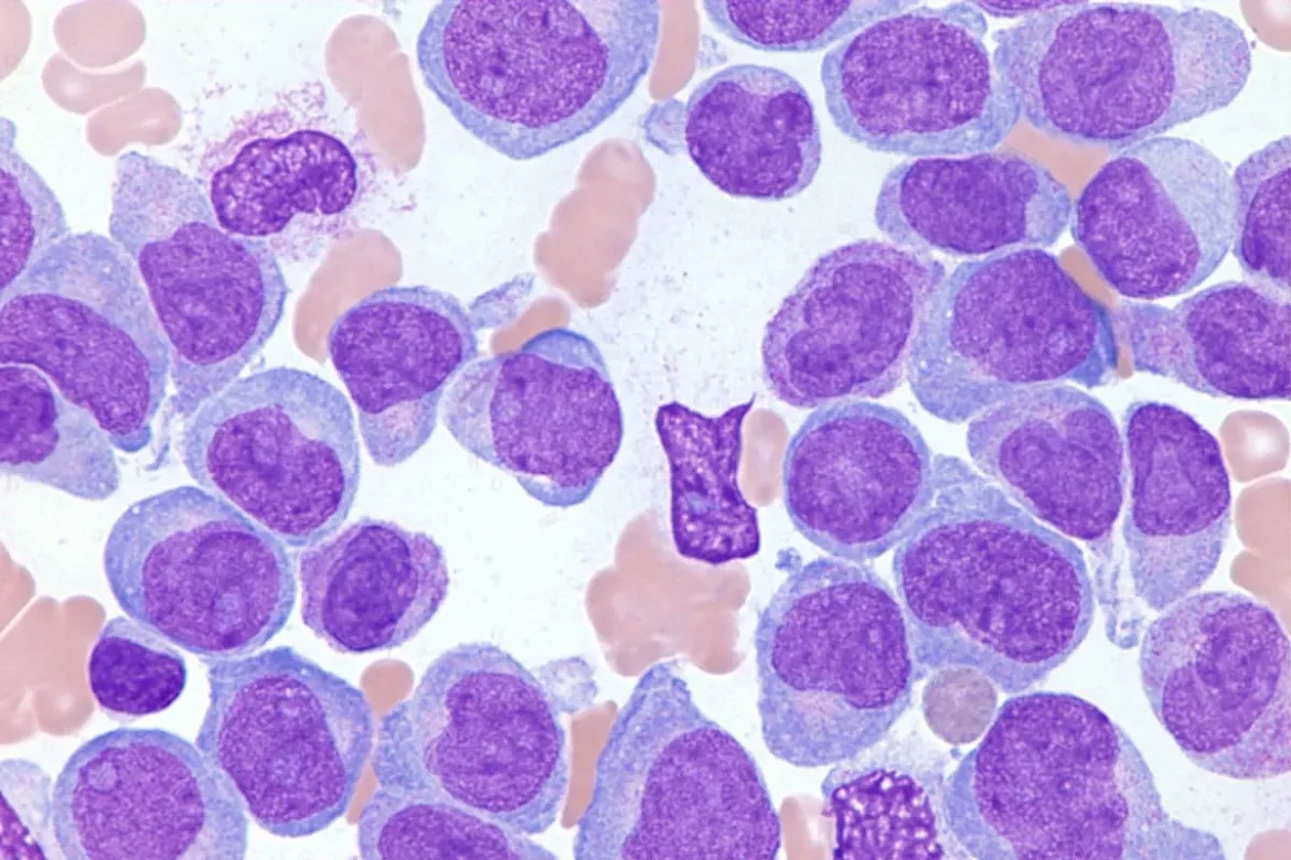 Nuevos descubrimientos: optimizan el pronóstico de la leucemia