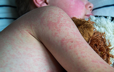 Solicitan a quienes viajaron en ómnibus por Entre Ríos estar atentos ante posible exposición al sarampión